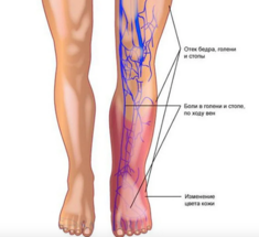 Варикоз: как распознать и остановить болезнь на ранней стадии