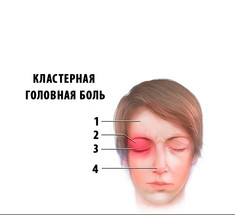 Кластерная головная боль: профилактика и лечение