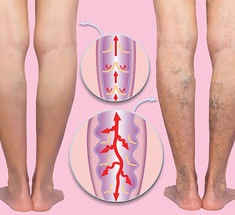 Врач назвала одну из главных причин варикоза