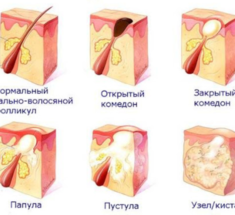 Как избавиться от подкожных прыщей без косметолога