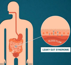 Как лечить синдром повышенной кишечной проницаемости?