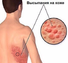 Опоясывающий лишай: лечение натуральными средствами