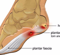 Плантарный фасциит: Узнайте как облегчить боль при помощи простого средства!