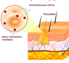 Папилломы исчезнут! 5 эффективных методик