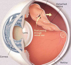 Отслойка сетчатки: что важно знать