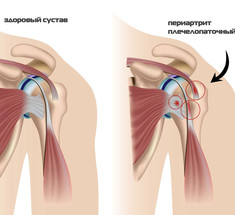 Плечелопаточный периартрит: упражнения врача-реабилитолога Попова 