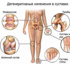 БОЛЬНЫЕ СУСТАВЫ: весенняя очистка 