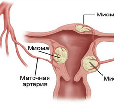 МИОМА МАТКИ: как обойтись без операций и гормональной терапии