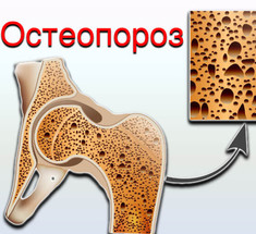 ОСТЕОПОРОЗ: ЧТО НЕОБХОДИМО ЗНАТЬ ЖЕНЩИНАМ 50+
