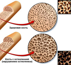 Остеопения: Коварная болезнь с бессимптомным течением 