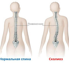 Приобретенный сколиоз: Лечение по методике Гитта