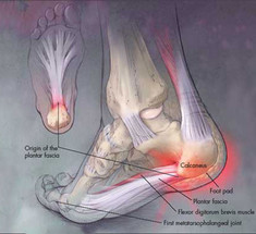 Плантарный фасциит: Причины и риски появления 