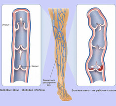 Слабые вены: Упражнения для предотвращения варикоза