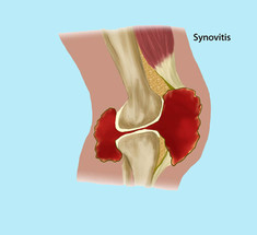 Синовит коленного сустава: Что делать?