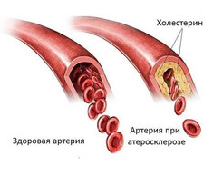 Закупорка сосудов: Основные причины и симптомы 