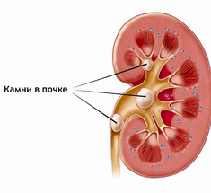 Откуда берутся камни в почках