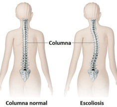 СКОЛИОЗ: Простые упражнения для коррекции 