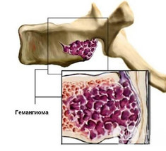 ГЕМАНГИОМА ПОЗВОНОЧНИКА: Стоит ли бояться?