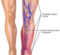 5 самых частых симптомов тромбоза вен нижних конечностей