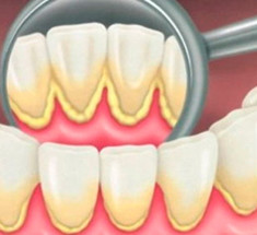 12 советов, которые помогут предупредить образование зубного камня