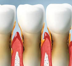 Где тонко, там и рвется: Пародонтит грозит поражением внутренних органов