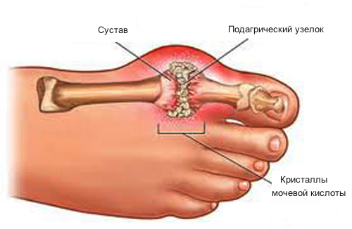 Подагра: симптомы и лечение