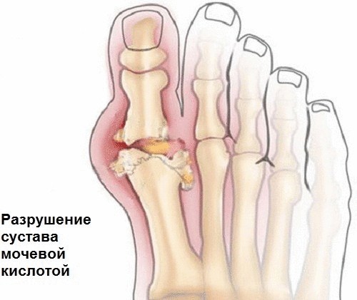 В чем опасность мочевой кислоты и как можно уменьшить ее количество?