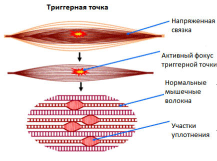 Миофасциальный массаж: что, как и для кого?