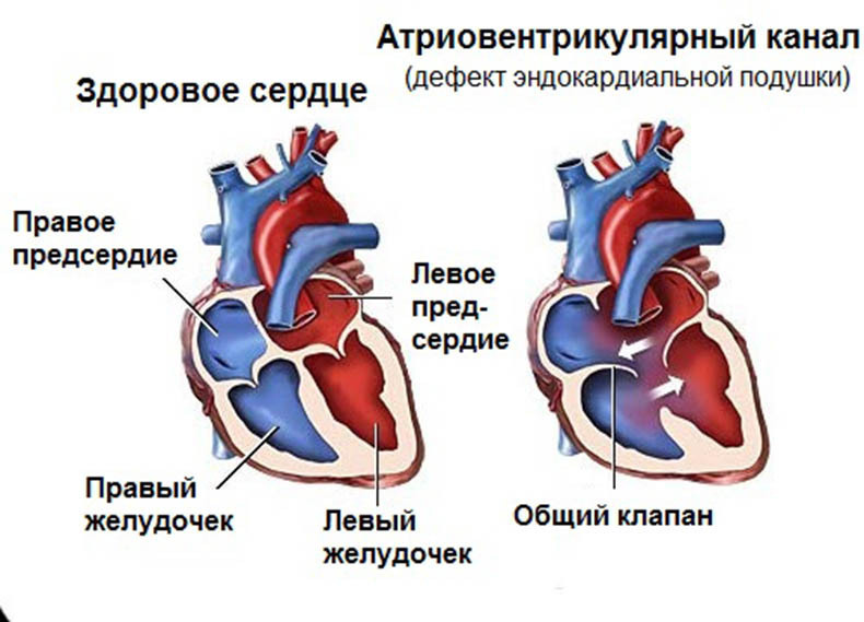 Шумы в сердце: что нужно знать?