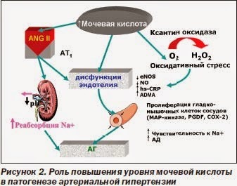 Чем грозит бессимптомный высокий уровень мочевой кислоты 