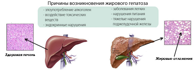 Узнайте, что такое висцеральный жир и чем он опасен