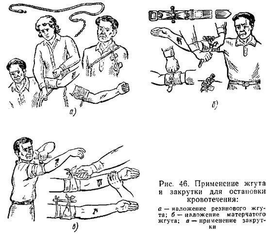 Приемы и способы остановки кровотечений, правила наложения повязок про ранениях