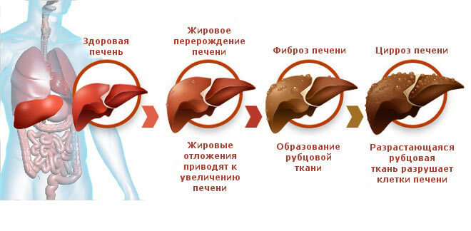 Мягкое очищении печени по методике Андреаса Морица