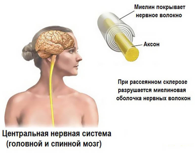 Исцеление от рассеянного склероза: личный опыт.Часть 1