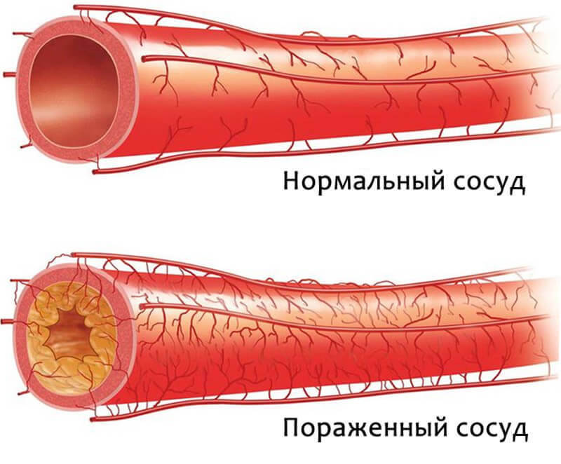 Доказано! Как избавиться от атеросклероза сосудов 