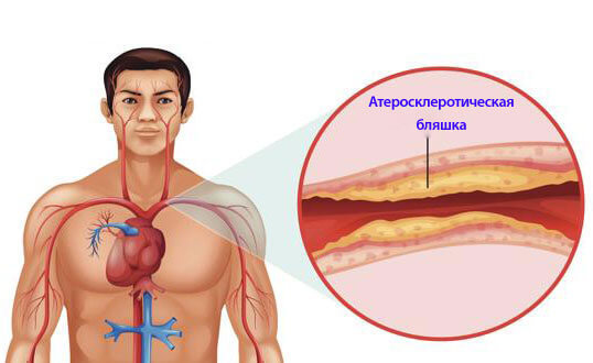 Доказано! Как избавиться от атеросклероза сосудов 