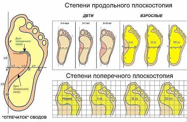 Как исправить плоскостопие