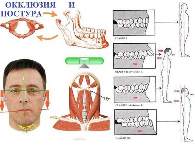 Болит голова — проверьте прикус!