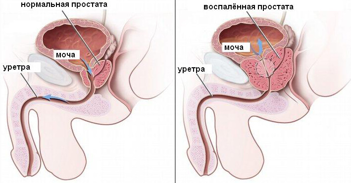 Методы остеопрактики при простатите — лечение без антибиотиков