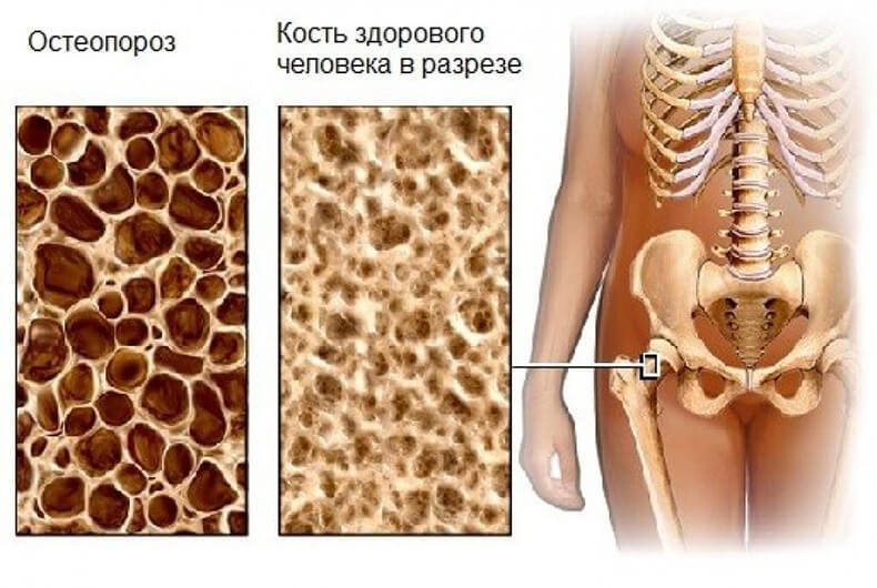 Кому грозит остеопороз