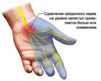 Упражнения для рук при ТУННЕЛЬНОМ СИНДРОМЕ