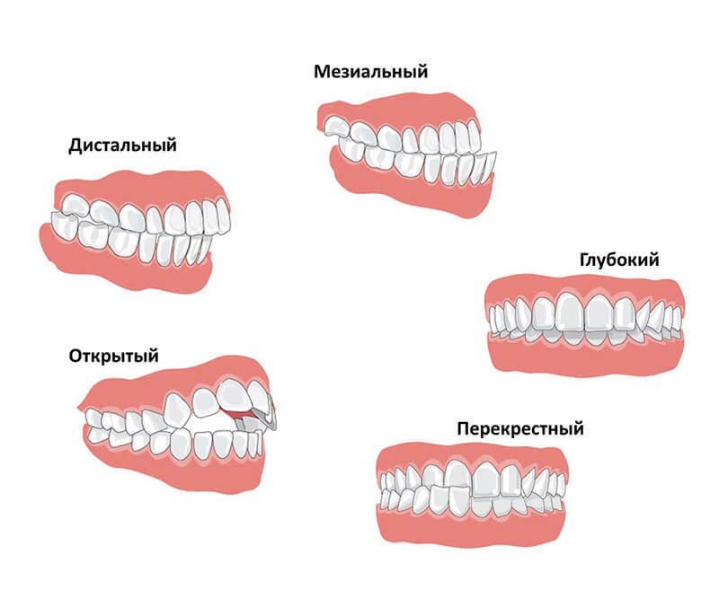 Это нужно знать! Истинные причины неправильного прикуса 