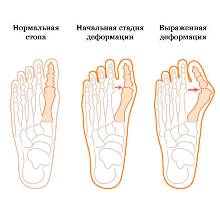 Вылечить Hallux Valgus, "косточку", без операции ВОЗМОЖНО!