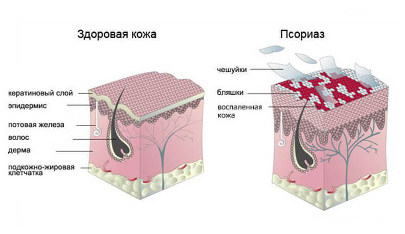 Псориаз — не заболевание кожи!