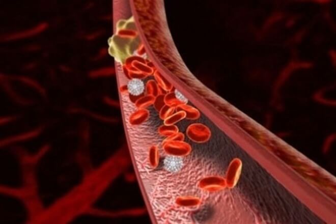 Важно! От чего образуются тромбы в сосудах: 3 основные причины