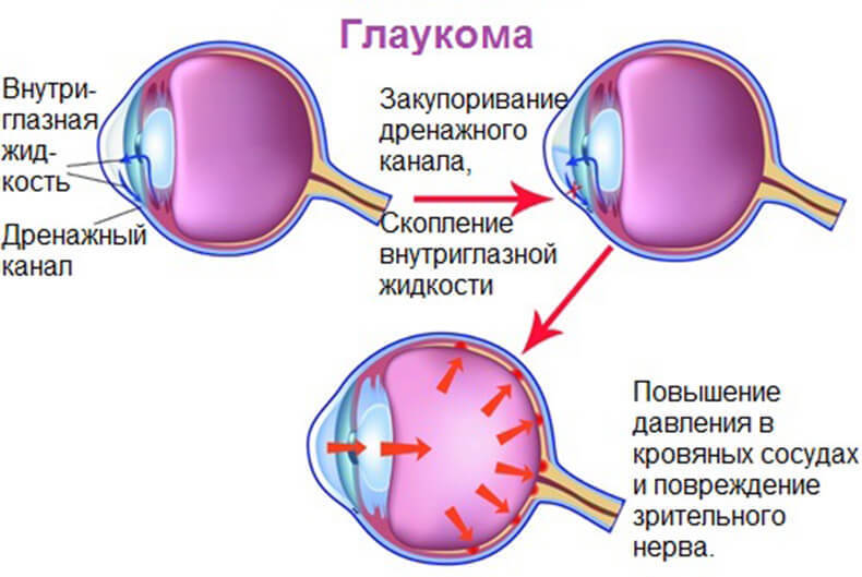 Глаукома: почему возникает и как предотвратить заболевание