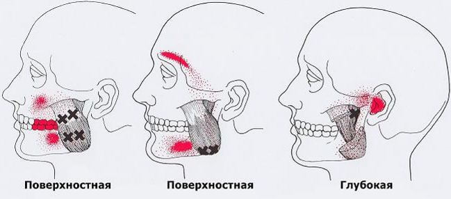 Триггеры: Карта точек боли и напряжения в теле 