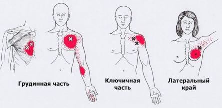 Триггеры: Карта точек боли и напряжения в теле 