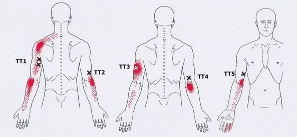 Триггеры: Карта точек боли и напряжения в теле 