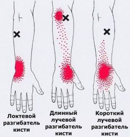 Триггеры: Карта точек боли и напряжения в теле 